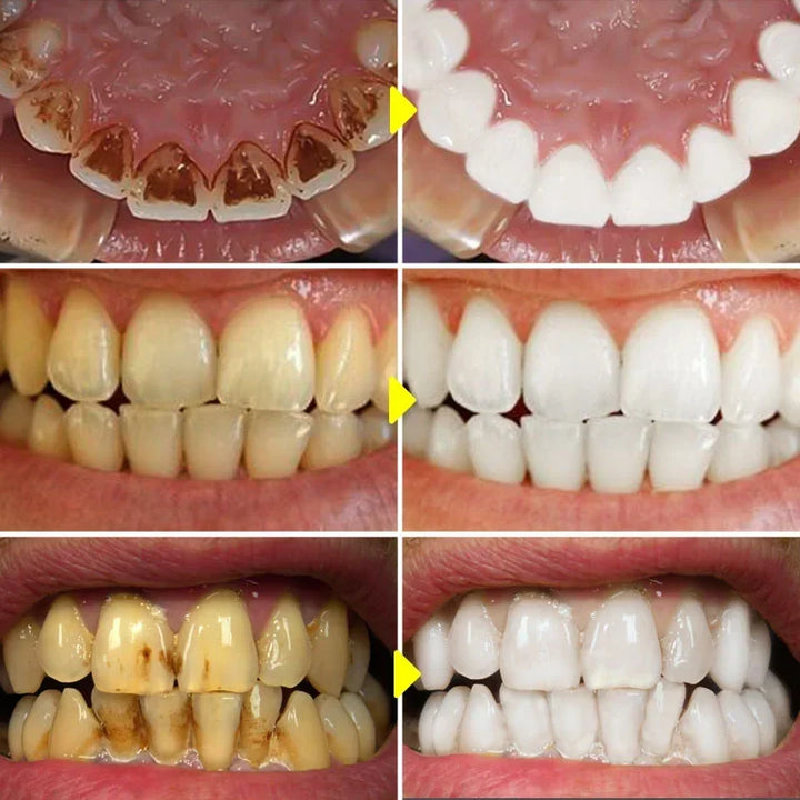 Probiotic Toothpaste SP-6 Whitening Tooth Stain Remover 120g